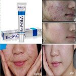 BIOAQUA Pure Skin Acne Removal Cream Acne Cream Treatment Acne Scar Removal Cream