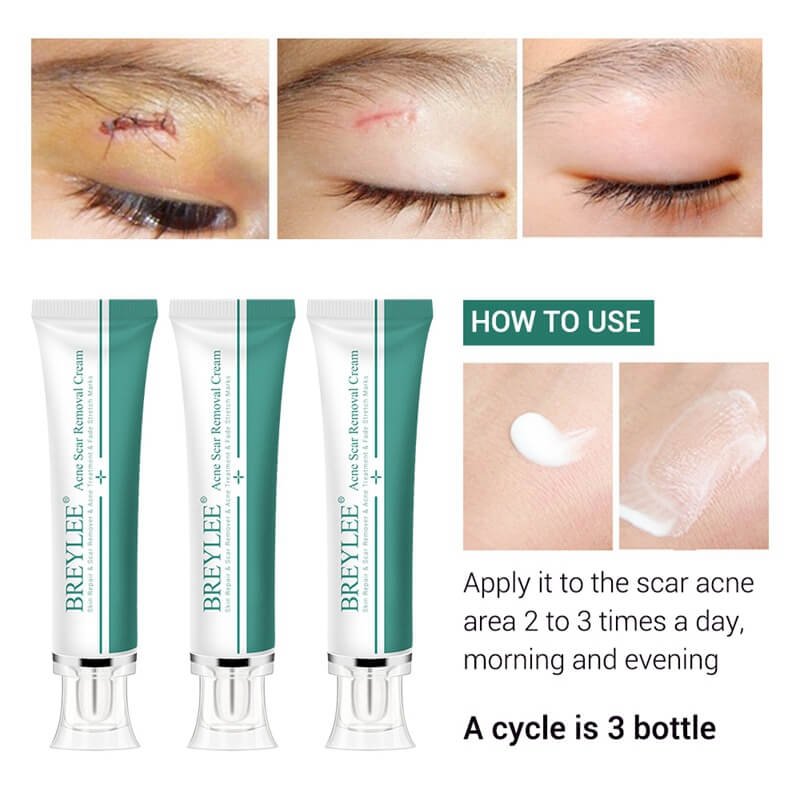 BREYLEE-acne-scar-removal-cream-treatment-price