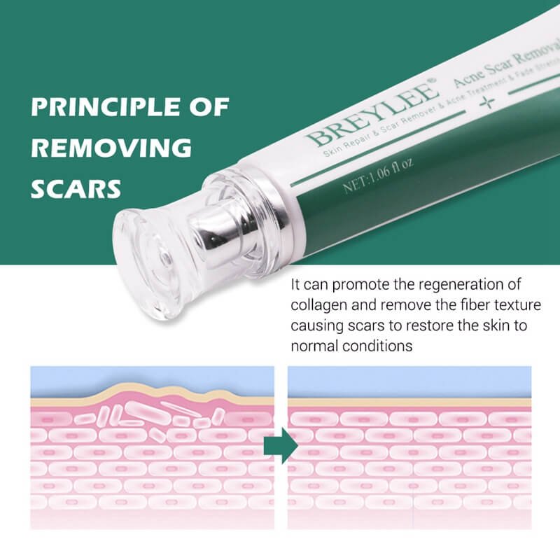 BREYLEE-acne-scar-removal-cream-treatment-shopping